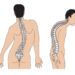 Các dạng cong vẹo cột sống: Những điều bạn cần đặc biệt lưu ý