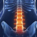 Viêm cột sống dính khớp là gì? Triệu chứng và cách điều trị