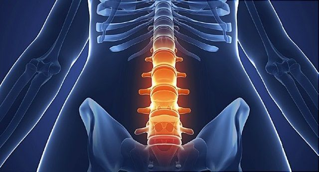 Viêm cột sống dính khớp là gì? Triệu chứng và cách điều trị