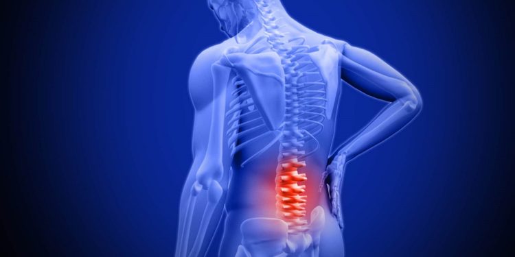 Hẹp ống sống: Nguyên nhân, triệu chứng và cách điều trị