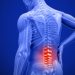 Hẹp ống sống: Nguyên nhân, triệu chứng và cách điều trị