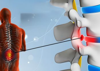 Phồng đĩa đệm: Nguyên nhân, triệu chứng và cách điều trị