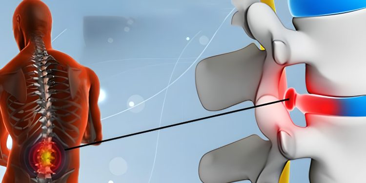 Phồng đĩa đệm: Nguyên nhân, triệu chứng và cách điều trị