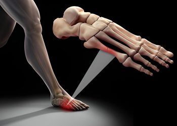 Rạn xương là gì? Nguyên nhân, dấu hiệu và cách điều trị