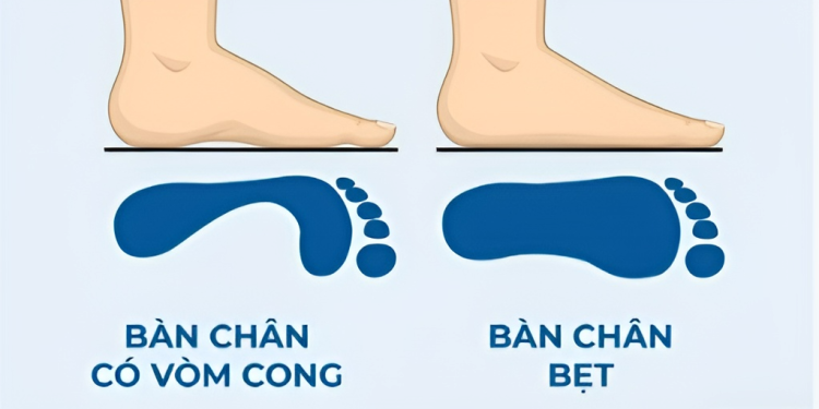 Bàn chân bẹt là gì? Nguyên nhân, triệu chứng và phương pháp phòng ngừa