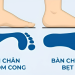 Bàn chân bẹt là gì? Nguyên nhân, triệu chứng và phương pháp phòng ngừa