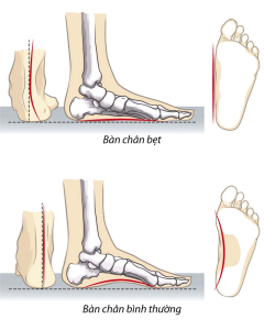 Bàn chân bẹt là hiện tượng mặt lòng bàn chân bằng phẳng và không có độ lõm