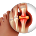 Bệnh gout là gì? Nguyên nhân, triệu chứng và cách điều trị