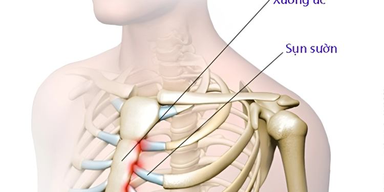 Gãy xương ức là gì? Nguyên nhân, triệu chứng và phương pháp điều trị