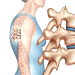 Bệnh loãng xương ở người già: Nguyên nhân và cách điều trị