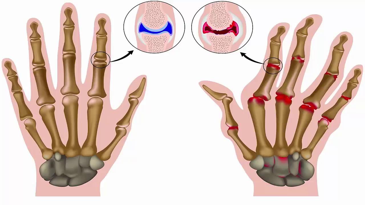 Bệnh xuất hiện khi tế bào miễn dịch bị tấn công và phá hủy hệ thống xương sụn trong khớp