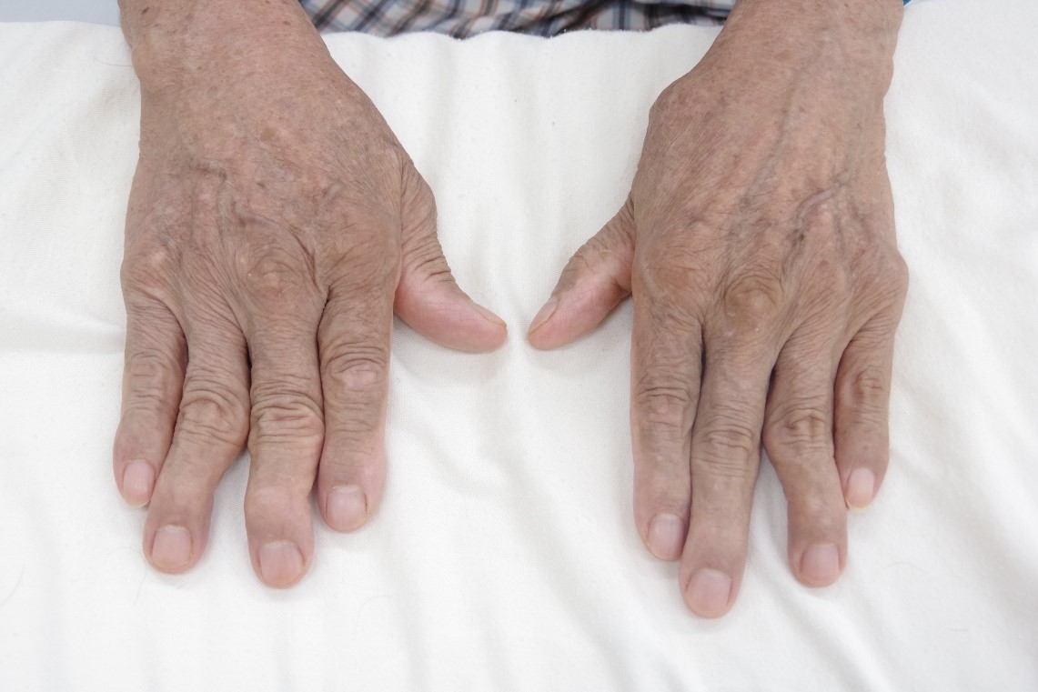 Người bị bệnh viêm đa khớp dạng thấp có khả năng cao bị ung thư hạch