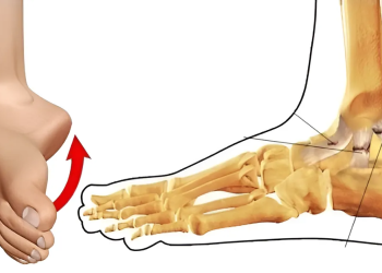 Nứt xương bao lâu thì lành? Nguyên nhân, triệu chứng và cách điều trị