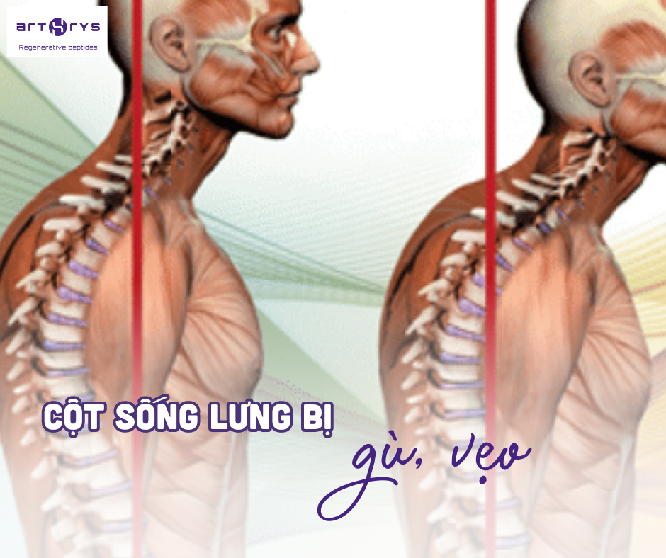 Dấu hiệu loãng xương là cột sống bị gù vẹo