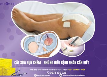Cắt sửa sụn chêm – Những điều bệnh nhân cần biết