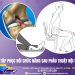 Bài tập phục hồi chức năng sau phẫu thuật nội soi khớp gối