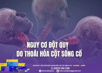Nguy cơ đột quỵ do thoái hóa cột sống cổ